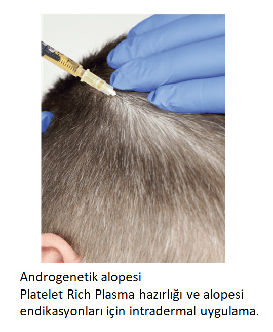 Regenlab-alopezi
